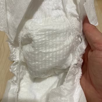 Bebek Bezinde Kristal Benzeri Madde Ve Pişik Sorunu