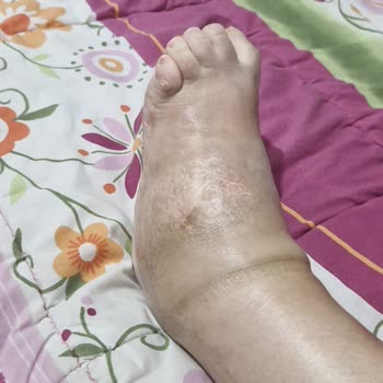 Ayak Ameliyatı Sonrası His Kaybı Ve Maddi Manevi Mağduriyet Yaşadım