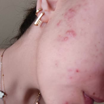 I Used La Roche-Posay Face Wash and It Ruined My Skin with Severe Irritation