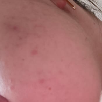 I Used La Roche-Posay Face Wash and It Ruined My Skin with Severe Irritation