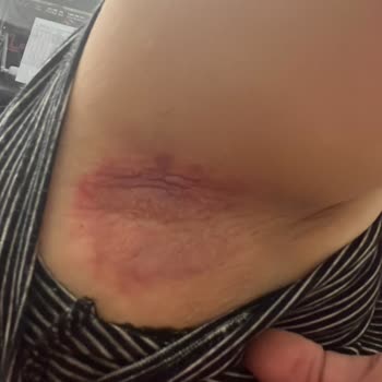 Doğal Olduğu İddia Edilen Ürün Cildimde Yanık Oluşturdu