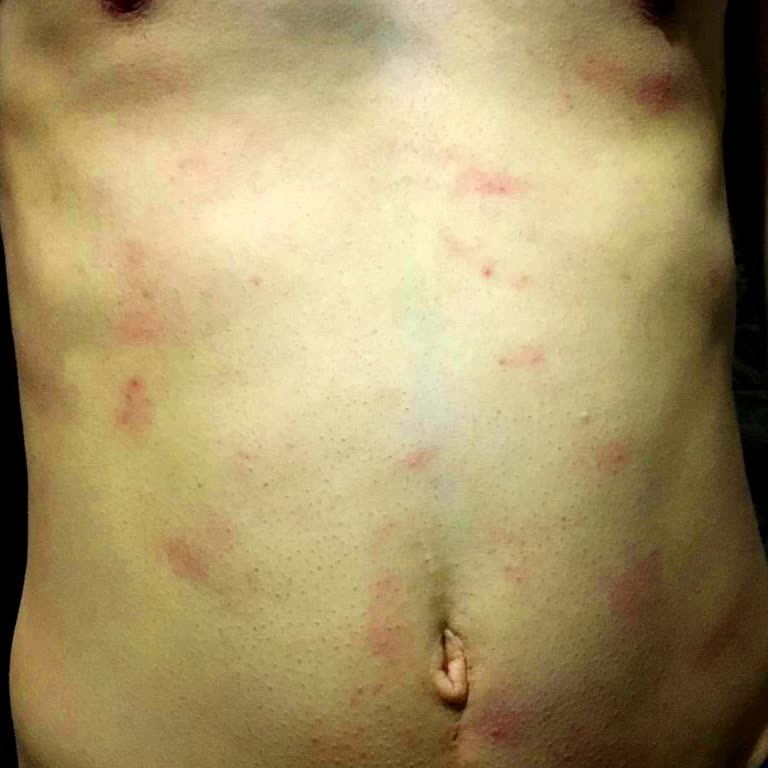 Krem Kullanımı Sonrası Ciltte Yanık Ve Kaşıntı Problemi