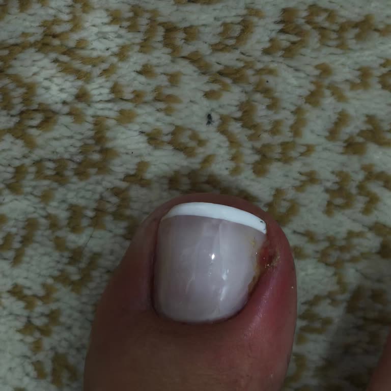 Yanlış Pedikür Sonrası İltihap Ve İlgisizlik