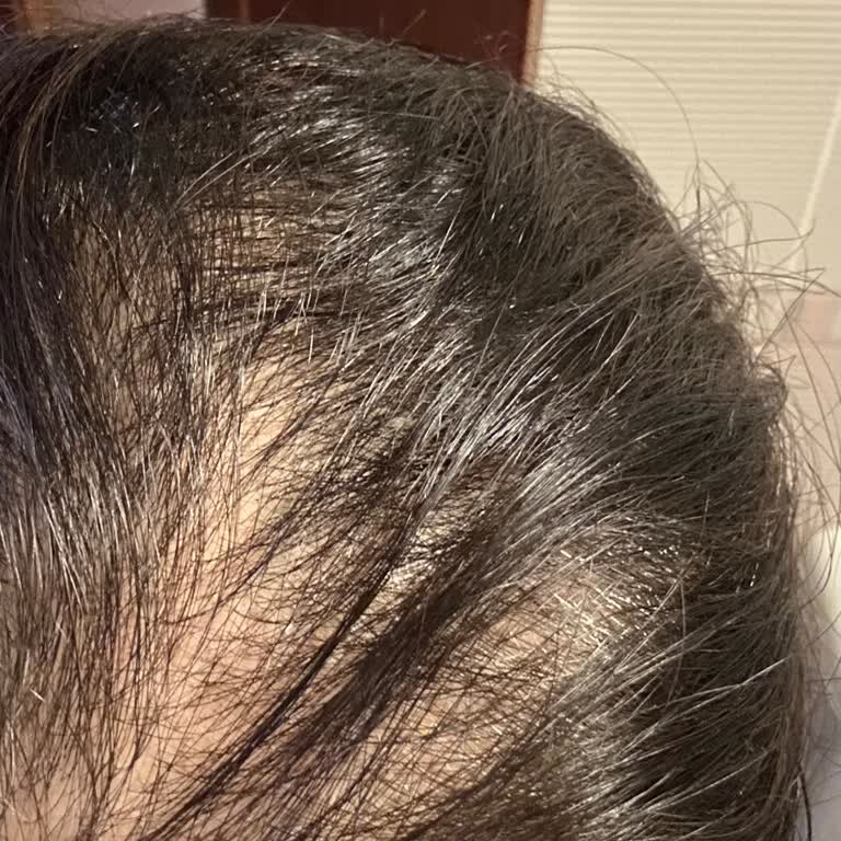 Estetisyen Sibel İğci Saç Çıkarma Vaadiyle Mağduriyet Ve İletişimsizlik