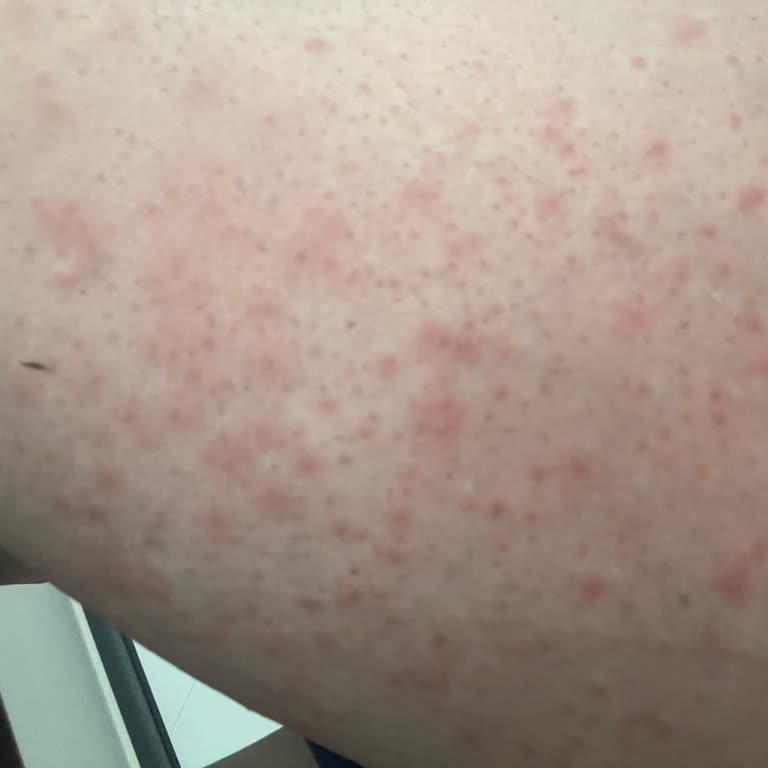 Veet Tüy Dökücü Krem Cildimi Mahvetti!