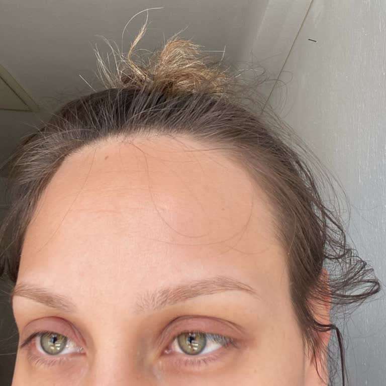 Gözaltı Serumundan Sonra Şiddetli Kaşıntı Ve Şişlik Yaşadım