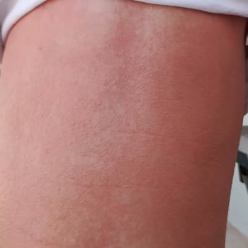 Çocuğumun Cildinde Güneş Kremi Sonrası Ciddi Yanık Ve Alerji