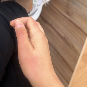 Stanley Termos Kapağı Patladı Ellerimde Yanık Oluştu