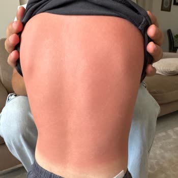 Sebamed Sunscreen Failed to Protect My 3-Year-Old Despite Multiple Reapplications