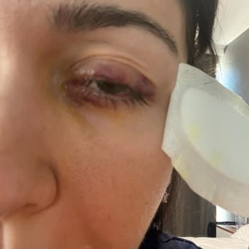 Milagro Simply Fresh Portakal Suyu Şişesi Kapağı Gözüme Fırladı Ciddi Göz Hasarı Yaşadım