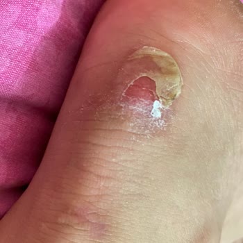 Puma Ayakkabı Ayağımı Yaraladı, Mağdur Oldum!