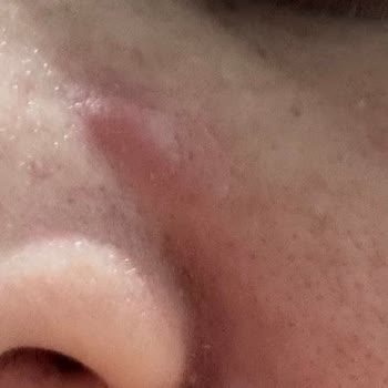 Yves Rocher Ürünleri Cildimde Ağrılı Sivilcelere Sebep Oldu