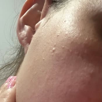 Yves Rocher Ürünleri Cildimde Ağrılı Sivilcelere Sebep Oldu