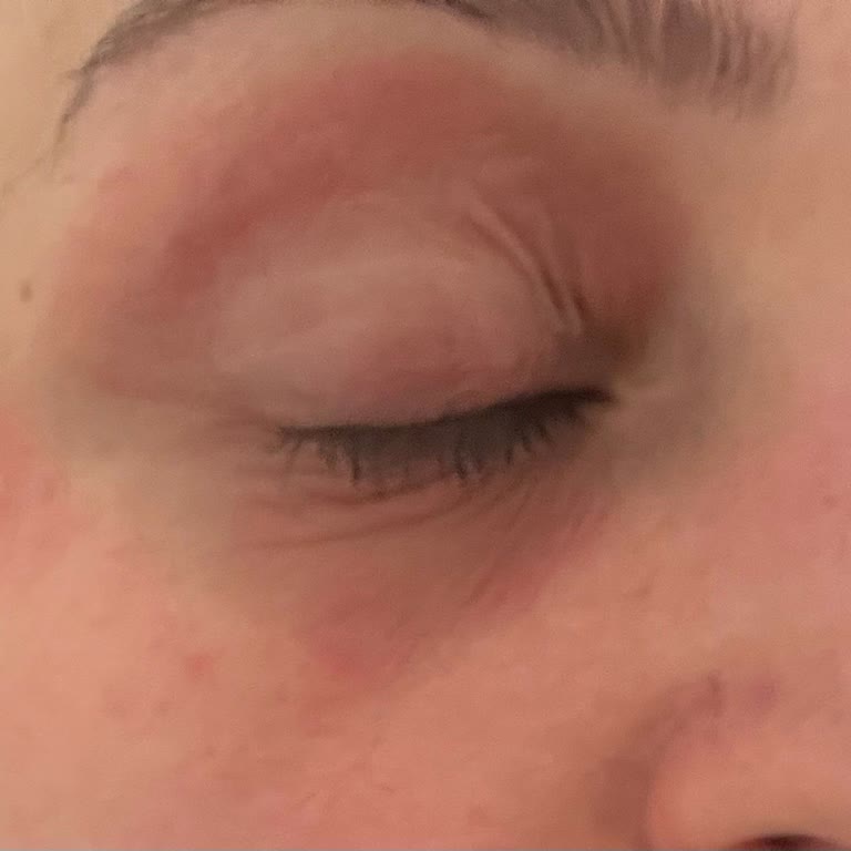 Garnier Temizleme Suyu Cildimde Alerjik Reaksiyona Sebep Oldu