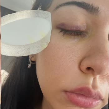 Yemeksepeti Market Portakal Suyu Şişesi Patladı, Gözümde Kalıcı Hasar Oluştu Mağduriyetim Büyük!