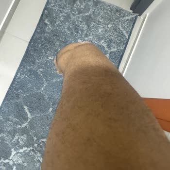 Lazer Epilasyon Sonrası Artan Ve Kalınlaşan Tüyler