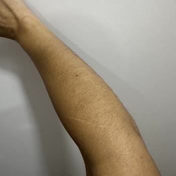 Lazer Epilasyon Sonrası Artan Ve Kalınlaşan Tüyler