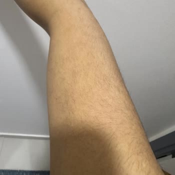 Lazer Epilasyon Sonrası Artan Ve Kalınlaşan Tüyler