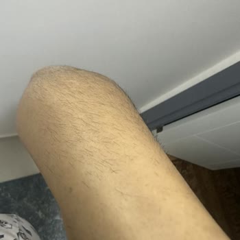 Lazer Epilasyon Sonrası Artan Ve Kalınlaşan Tüyler