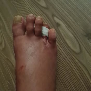 Kocaeli Şehir Hastanesi Ayağımı Mahvetti