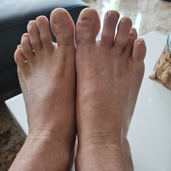 Kocaeli Şehir Hastanesi Ayağımı Mahvetti