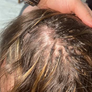 Kuaförde Kaynak İşlemi Sonrası Saç Derimde Yaralar Oluştu