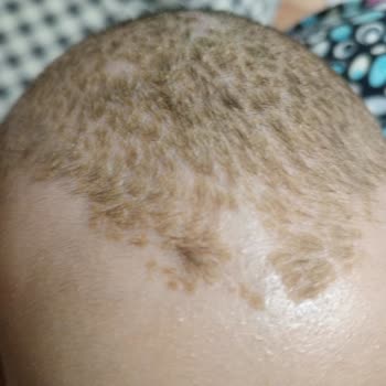 Bebek Şampuanı Ciltte Egzama Ve Kızarıklığa Sebep Oldu