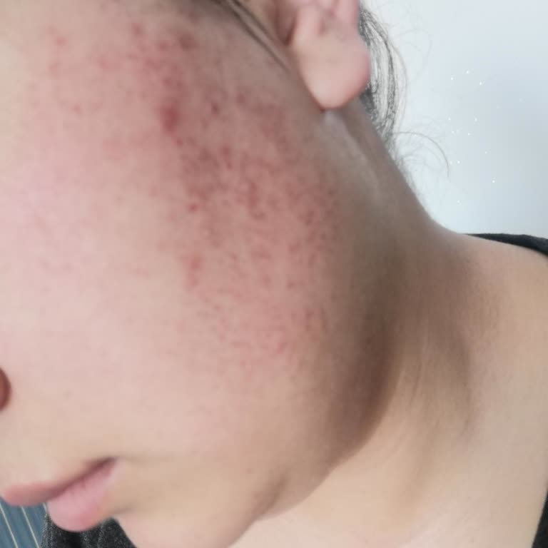 Deneyimsiz Personel Nedeniyle Yüzümde Yanık Oluştu, Mağduriyetim Giderilmedi