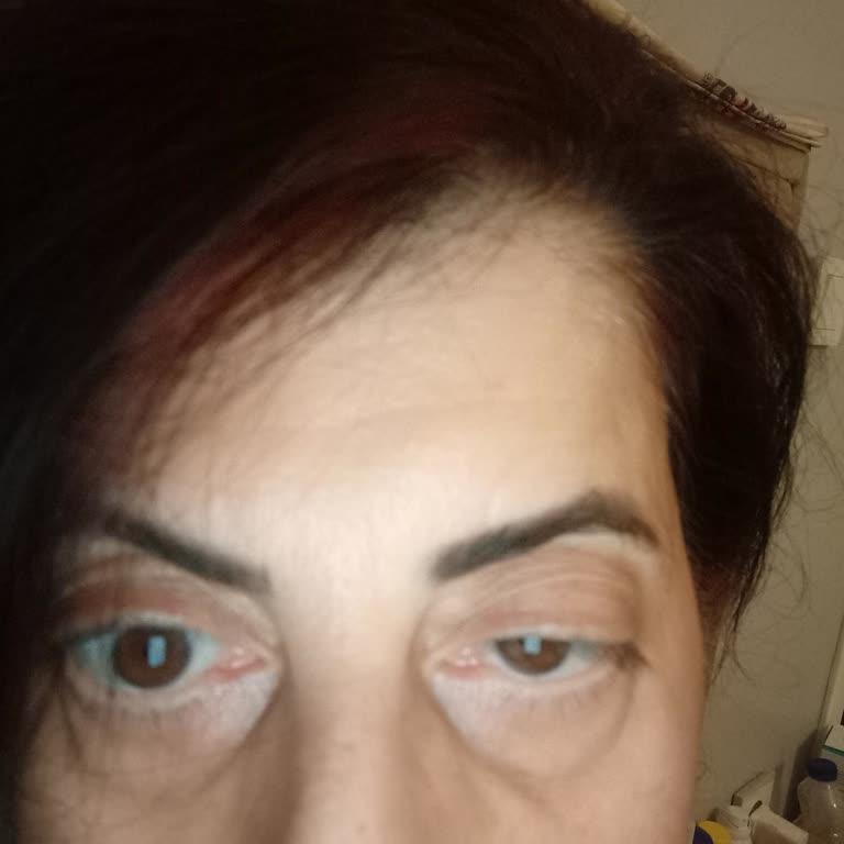 Botoks Sonrası Tekrar Eden Göz Kapağı Düşüklüğü Ve Denetim Eksikliği Endişesi