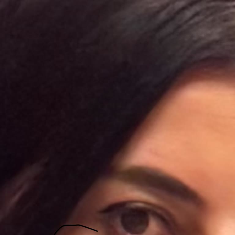 Liva Clinic (Bakırköy) Gözaltı Dolgu İşlemi Sonrası Yaşanan Sorunlar ve İletişim Sıkıntısı