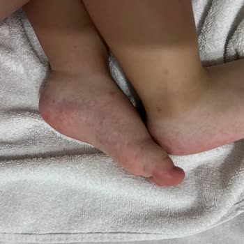 Oteldeki Hijyen Eksikliği Ve Çocuğumun Sağlık Sorunu