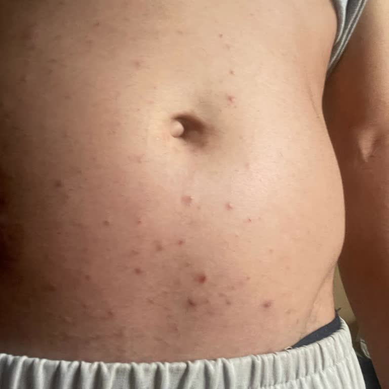 Lazer Epilasyon Sonrası Cilt Lekeleri Ve İlgisiz Hizmet