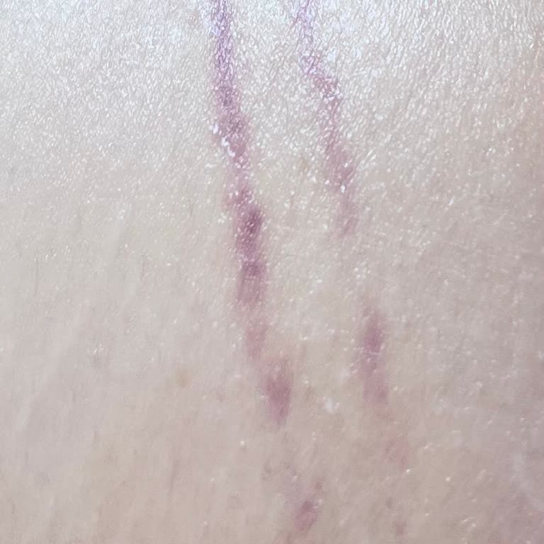 Metropolitan Sağlık Danışmanlığı Viva Danışmanlık Bakıcı Anneme Fiziksel Şiddet Uyguladı Ama İlgilenmiyorlar