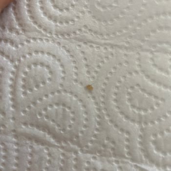 Dondurmada Yabancı Cisim Ve Hijyen Sorunu