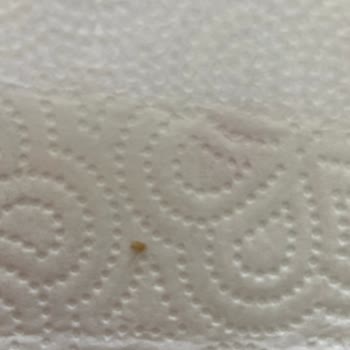 Dondurmada Yabancı Cisim Ve Hijyen Sorunu