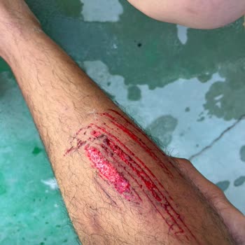 Su Kaydırağı Merdiveninde Yaşanan Güvenlik Sorunu Ve Yetersiz İlk Yardım