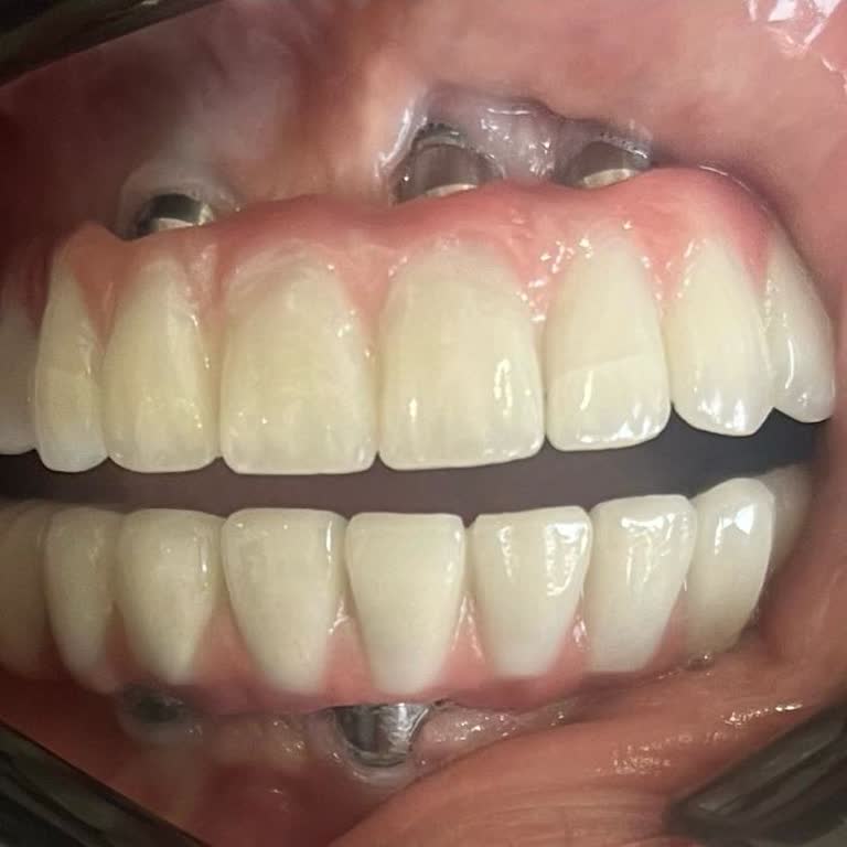 Yanlış İmplant Uygulaması Sonucu Maddi Ve Manevi Zarar