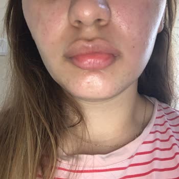 Alerji Yapan Ürün İçin Hızlı Çözüm Bekliyorum