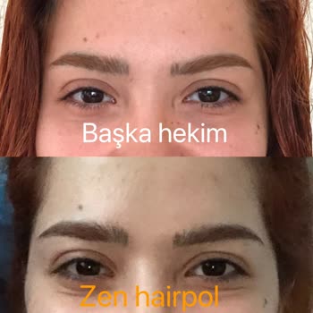 Botoks Sonrası Yüzümde Asimetri Ve Memnuniyetsizlik Yaşadım