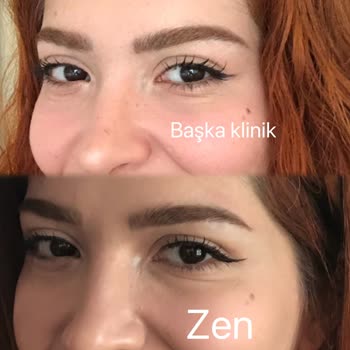 Botoks Sonrası Yüzümde Asimetri Ve Memnuniyetsizlik Yaşadım