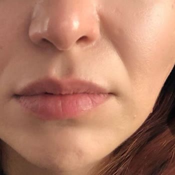 Botoks Sonrası Yüzümde Asimetri Ve Memnuniyetsizlik Yaşadım