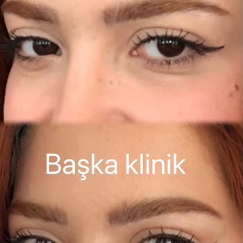 Botoks Sonrası Yüzümde Asimetri Ve Memnuniyetsizlik Yaşadım