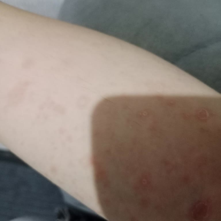 Sabun Kullanımı Sonrası Ciltte Şiddetli Kızarıklık Ve Tahriş