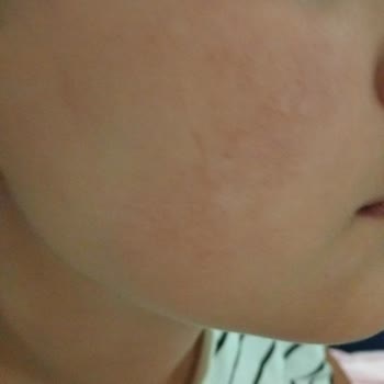 Kil Maskesi Sonrası Ciddi Kızarıklık Ve Yanma Yaşadım