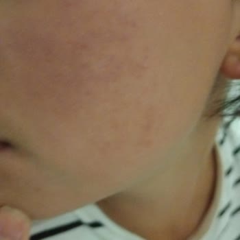 Kil Maskesi Sonrası Ciddi Kızarıklık Ve Yanma Yaşadım