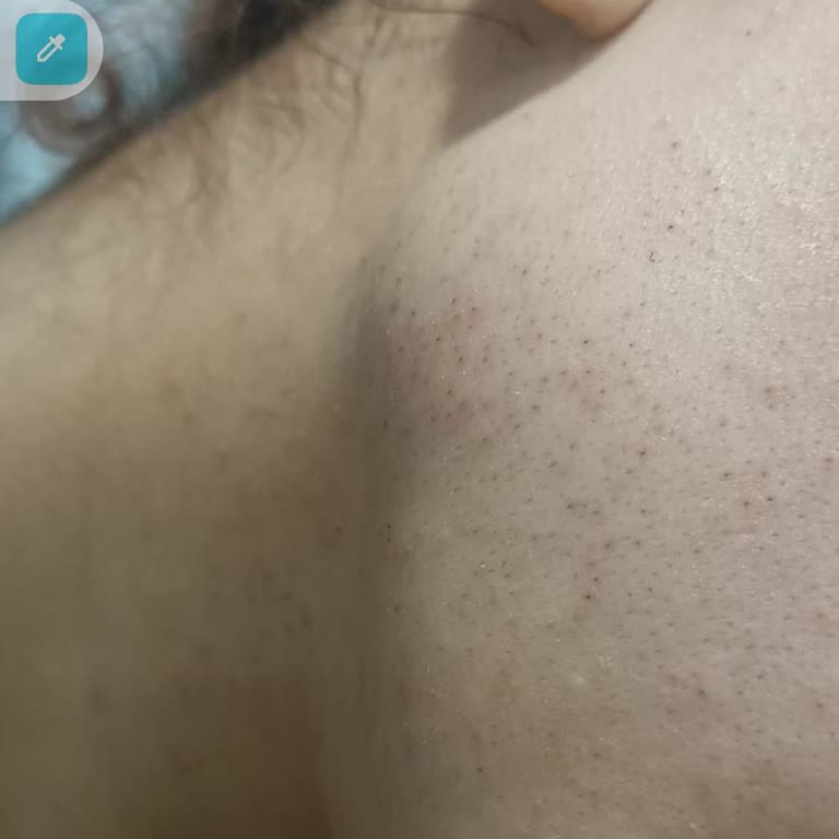 Lazer Epilasyon Sonuçsuz Kaldı, Ek Paket Satın Almam Bekleniyor