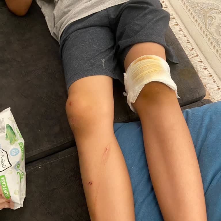 Yeni Alınan Scooter'ın Fren Arızası Sonucu Oğlum Kaza Geçirdi