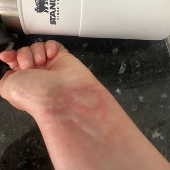 Stanley Termos Kapağı Patladı, El Bileğimde Ciddi Yanık Oluştu