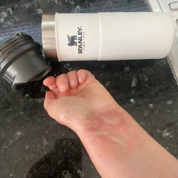 Stanley Termos Kapağı Patladı, El Bileğimde Ciddi Yanık Oluştu