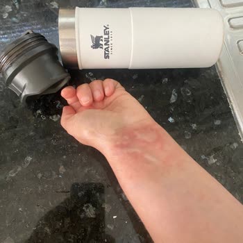 Stanley Termos Kapağı Patladı, El Bileğimde Ciddi Yanık Oluştu